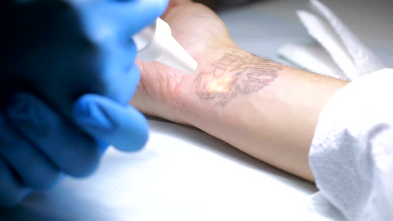 Laser tattoo removal with hand