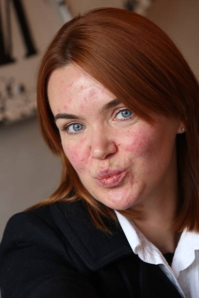istock Red haired girl with acne 629810590
