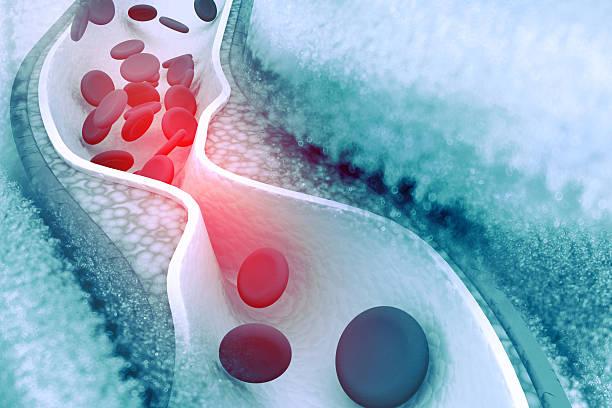 Cholesterol plaque in artery stock photo