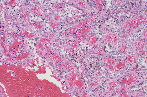Littoral cell angioma of the spleen is a rare vascular tumor. The tumor arises from the littoral cells in the splenic red pulp sinuses. Littoral cell angioma affects both men and women equally with no specific age predilection.