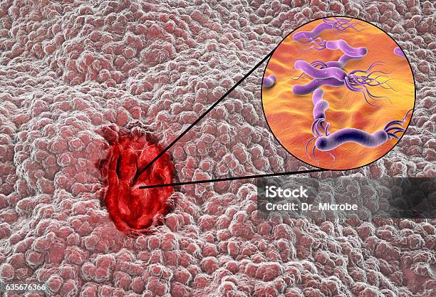 Mucosa Of Stomach With Peptic Ulcer And Bacterium Helicobacter Pylori Stock Photo - Download Image Now