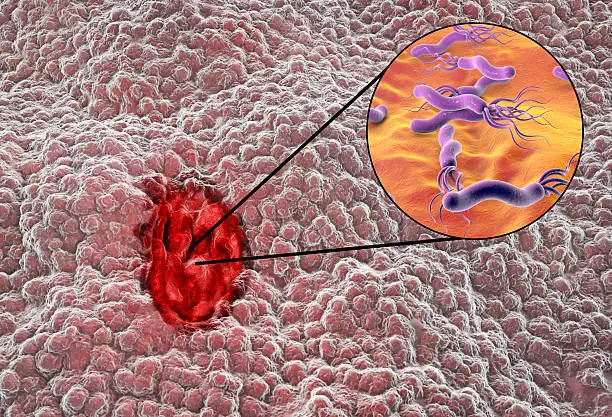 Photo of Mucosa of stomach with peptic ulcer and bacterium Helicobacter pylori