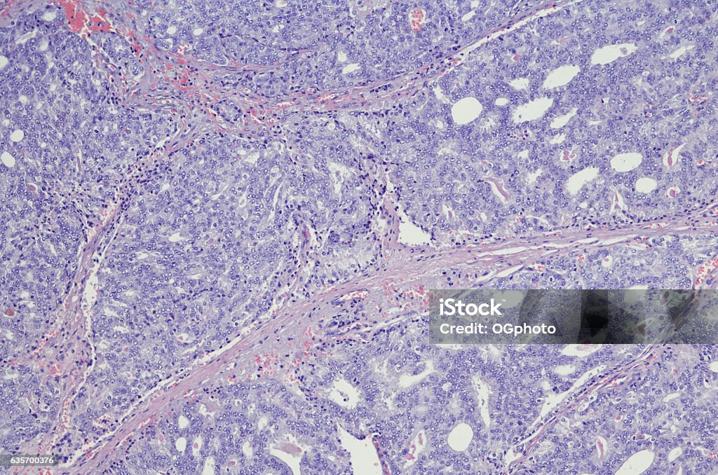 Micrograph of metastatic prostate carcinoma When prostate cancer spreads to other parts of your body, doctors say it is "metastatic" or that it has "metastasized." Metastasis is the medical term for cancer that has spread beyond the place where it started. It's still prostate cancer, even when it spreads. For example, metastatic prostate cancer in a bone in your hip is not bone cancer. It has the same prostate cancer cells the original tumor had, and your treatment options are the same as when cancer was only in your prostate gland. Metastatic prostate cancer is an advanced form of cancer. Although it can't be cured, it can be treated and controlled. Prostate Cancer Stock Photo