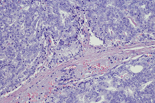 Micrograph of metastatic prostate carcinoma When prostate cancer spreads to other parts of your body, doctors say it is "metastatic" or that it has "metastasized." Metastasis is the medical term for cancer that has spread beyond the place where it started. It's still prostate cancer, even when it spreads. For example, metastatic prostate cancer in a bone in your hip is not bone cancer. It has the same prostate cancer cells the original tumor had, and your treatment options are the same as when cancer was only in your prostate gland. Metastatic prostate cancer is an advanced form of cancer. Although it can't be cured, it can be treated and controlled. light micrograph stock pictures, royalty-free photos & images