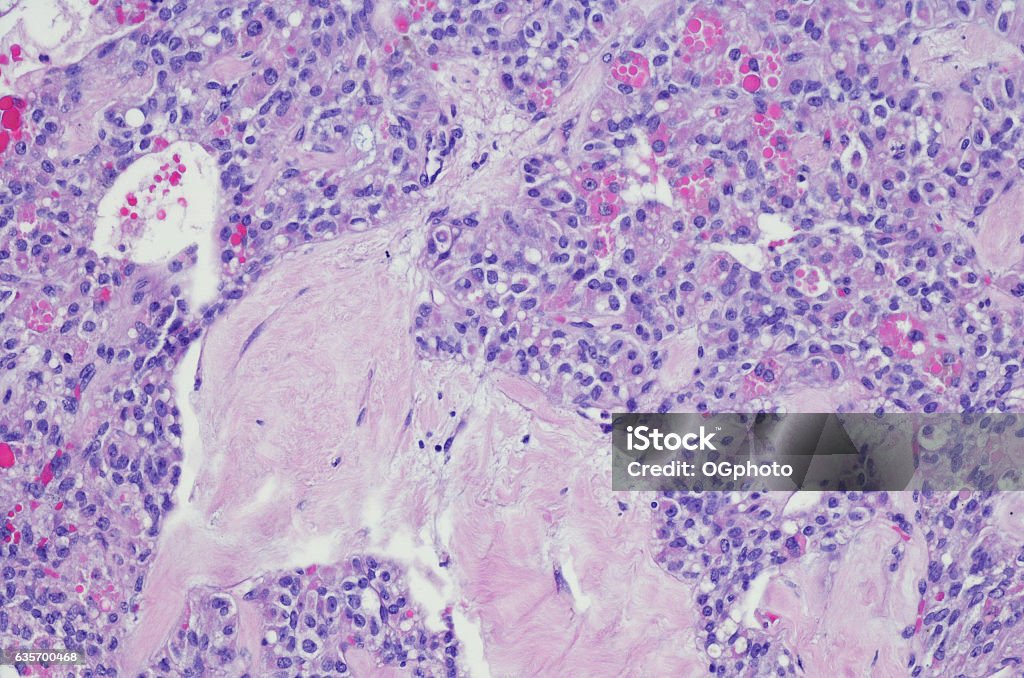 Solid pseudopapillary tumor (SPT) of the pancreas Solid pseudopapillary tumours (SPT) of the pancreas are rare (usually benign) pancreatic tumours. They are extremely rare and thought to account for 1-2% of exocrine pancreatic tumours. They tend to present in young non-Caucasian females around the 2nd and 3rd decades of life. Most patients are asymptomatic at diagnosis. They may occasionally present with a gradually enlarging abdominal mass or vague abdominal pain. The tumours frequently contain varying amounts of necrosis, haemorrhage, and cystic change. Lesions can be large at time of diagnosis (median size ~8 cm) 2. The tumour has been referred to with multiple different names, including: solid pseudopapillary tumour (SPT) of the pancreas, solid pseudopapillary neoplasm (SPN), solid pseudopapillary epithelial neoplasm (SPEN), papillary cystic neoplasm of the pancreas, Hamoudi tumour, Gruber-Frantz tumour (or just Frantz tumour) Anatomy Stock Photo