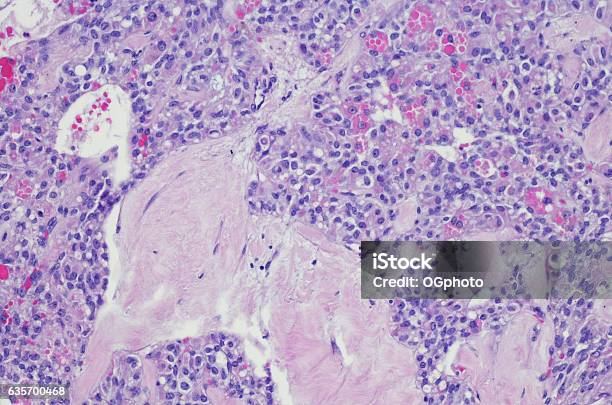 Solid Pseudopapillary Tumor Of The Pancreas Stock Photo - Download Image Now - Anatomy, Backgrounds, Benign Tumor