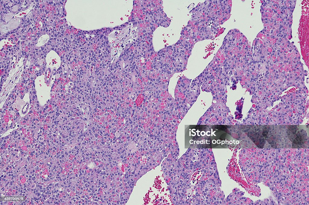 Solid pseudopapillary tumor (SPT) of the pancreas Solid pseudopapillary tumours (SPT) of the pancreas are rare (usually benign) pancreatic tumours. They are extremely rare and thought to account for 1-2% of exocrine pancreatic tumours. They tend to present in young non-Caucasian females around the 2nd and 3rd decades of life. Most patients are asymptomatic at diagnosis. They may occasionally present with a gradually enlarging abdominal mass or vague abdominal pain. The tumours frequently contain varying amounts of necrosis, haemorrhage, and cystic change. Lesions can be large at time of diagnosis (median size ~8 cm) 2. The tumour has been referred to with multiple different names, including: solid pseudopapillary tumour (SPT) of the pancreas, solid pseudopapillary neoplasm (SPN), solid pseudopapillary epithelial neoplasm (SPEN), papillary cystic neoplasm of the pancreas, Hamoudi tumour, Gruber-Frantz tumour (or just Frantz tumour) Anatomy Stock Photo