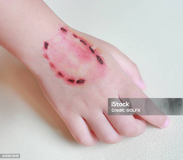Sticker Wound And Blood From A Bite Human Teeth Stock Photo - Download Image Now - Adult, Animal, Bruise