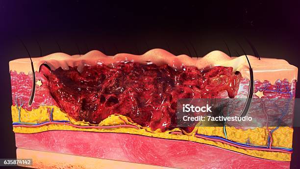 Third Degree Burn Stock Photo - Download Image Now - Burning, Wound, Physical Injury