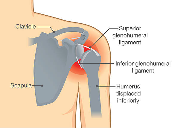 ilustrações de stock, clip art, desenhos animados e ícones de dislocation shoulder symptoms or separated. - x ray x ray image shoulder human arm