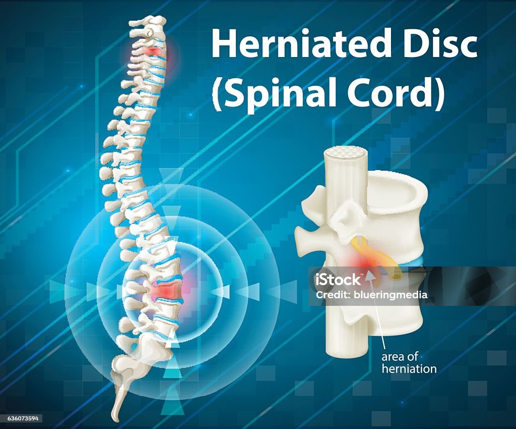 Diagram Showing Herniated Disc Stock Illustration - Download Image Now - Herniated Disc, Backache, Spine - Body Part - iStock Diagram Showing Herniated Disc Stock Illustration - Download Image Now - Herniated Disc, Backache, Spine - Body Part - iStock