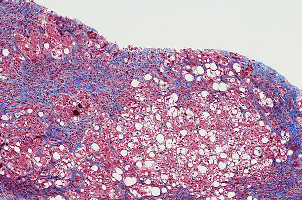 цирроз печени с печеночным стеатозом и хроническим гепатитом - magnification high scale magnification cell scientific micrograph стоковые фото и изображения