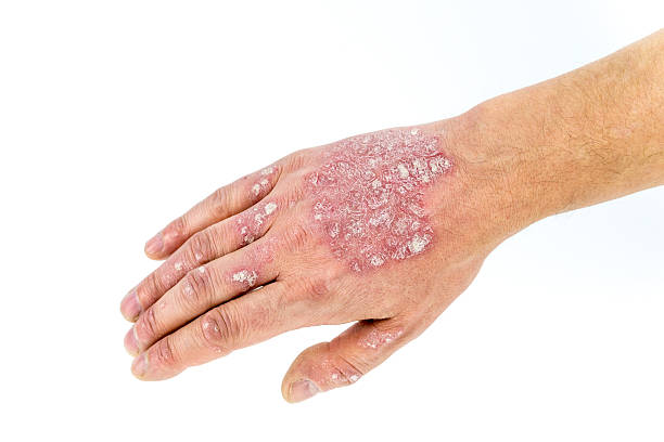 psoriasis on the hand isolated on white psoriasis on the hand isolated on white background photo psoriasis stock pictures, royalty-free photos & images