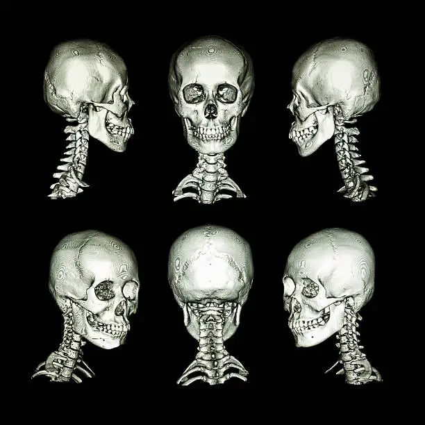 CT scan and 3D image . Normal human skull and cervical spine . all direction