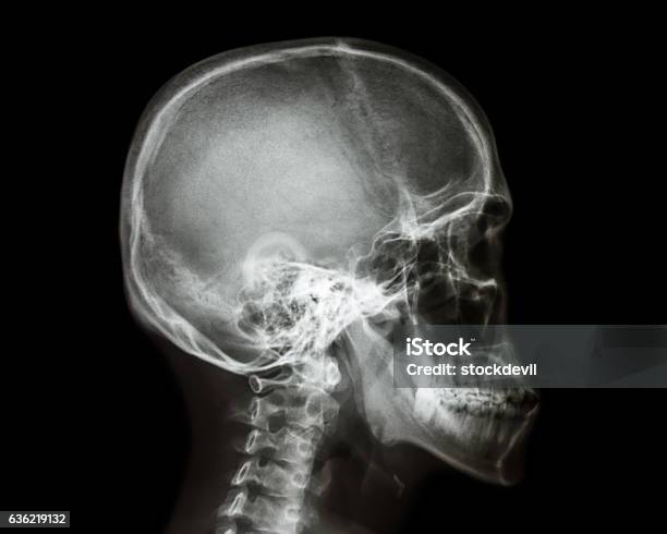 Film Xray Skull And Cervical Spine Lateral View Stock Photo - Download Image Now - X-ray Image, Letter X, Medical X-ray