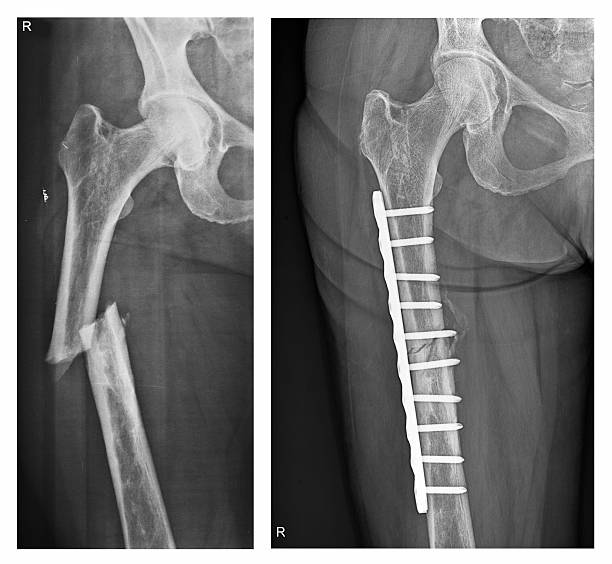 Femur Fracture before and after surgery X-ray of a femur fracture (broken thigh bone) before and after surgery. The fracture of the femoral shaft is not quite healed after the surgery. femur photos stock pictures, royalty-free photos & images