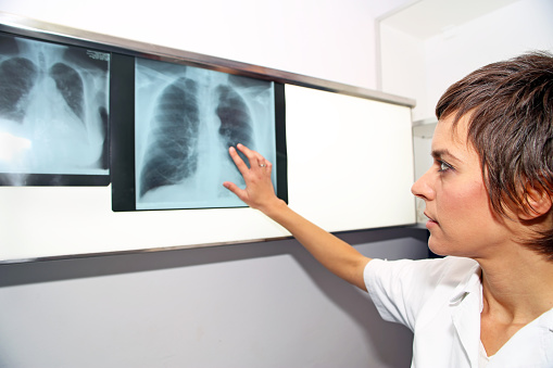 Doctor looks at X-ray images of lungs