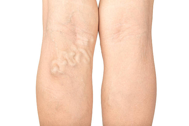 Varicose veins in the legs Varicose veins in the legs human limb stock pictures, royalty-free photos & images
