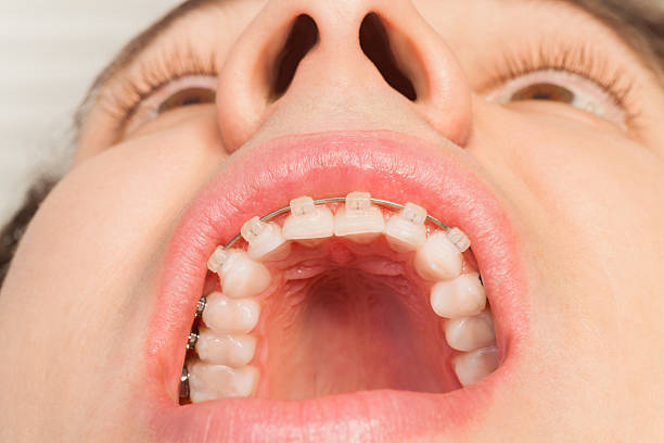 istock Man's wide opened mouth with dental braces 636858756
