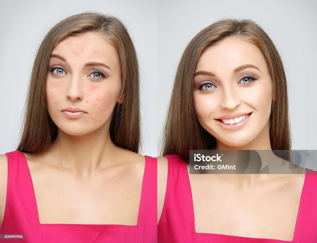 Rosacea.Girl  with problem and clear skin. Portrait of  girl  with problem and clear skin Acne Stock Photo