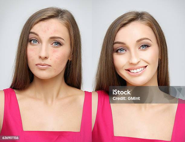 Rosaceagirl With Problem And Clear Skin Stock Photo - Download Image Now - Acne, Human Face, Rosacea - Skin Condition