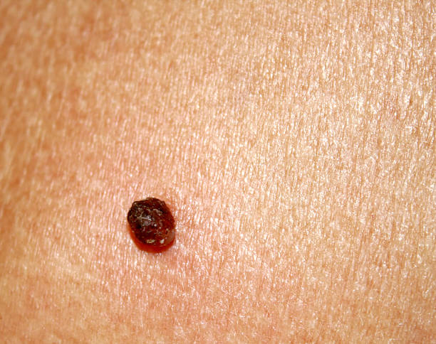 istock Birthmark on the skin 636950440