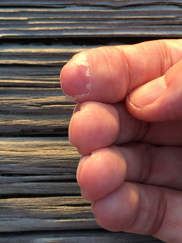 Skin peeling on index finger 17 days after frostbite damage due to prolonged exposure on a hike in freezing weather.