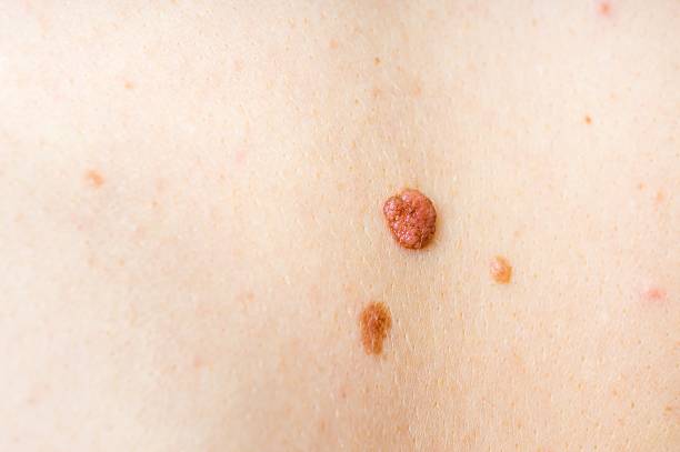 istock Woman with birthmark on her back 637130436