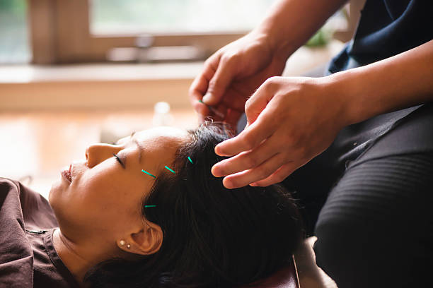 giovane donna in trattamento di agopuntura - acupuncture spa treatment asian culture medicine foto e immagini stock