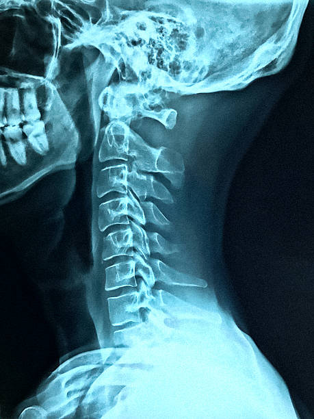 x-레이 목 - human spine mri scan x ray doctor 뉴스 사진 이미지