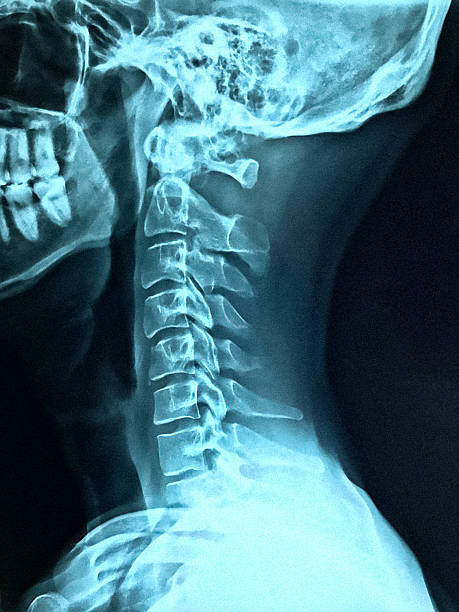 x-ray z szyjką - radiogram photographic image zdjęcia i obrazy z banku zdjęć