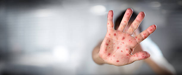 Viral Diseases - Hand Infected - Hand foot and mouth disease HFMD Viral Diseases - Hand Infected - Hand foot and mouth disease HFMD measles stock pictures, royalty-free photos & images