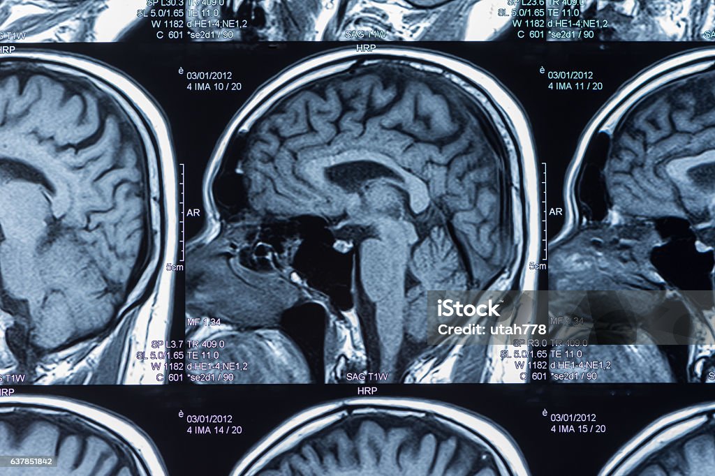risonanza magnetica cerebrale - Foto stock royalty-free di Apparecchiatura per la RMN