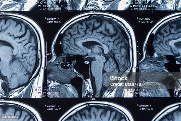 Risonanza Magnetica Cerebrale - Fotografie stock e altre immagini di Apparecchiatura per la RMN - Apparecchiatura per la RMN, RMN, Scansione medica