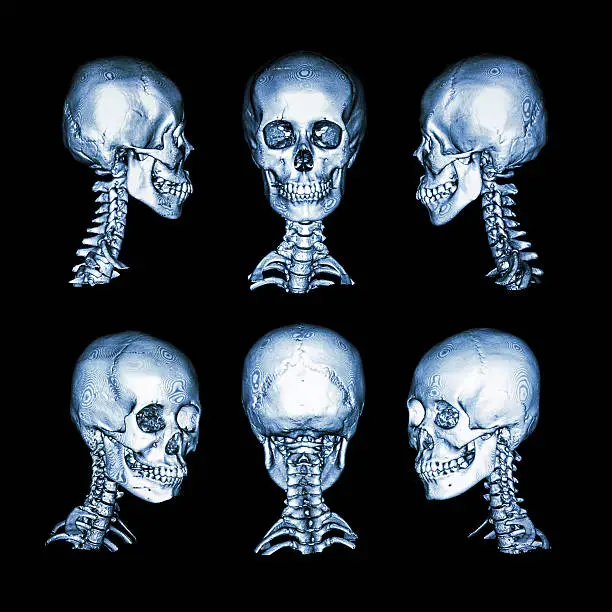 CT scan and 3D image . Normal human skull and cervical spine . all direction