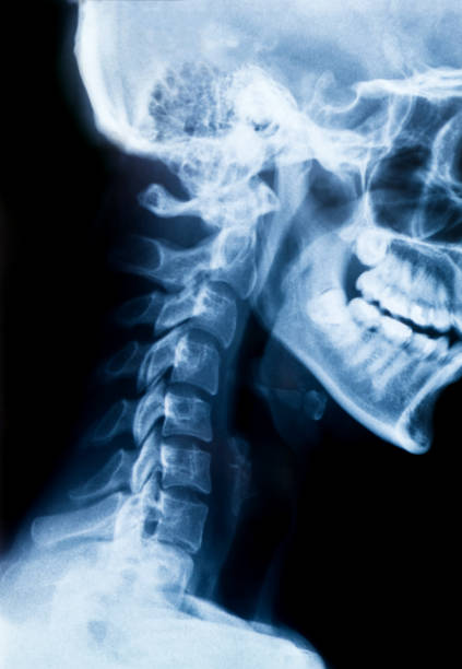 istock X-ray of the neck and skull - side view 638227228