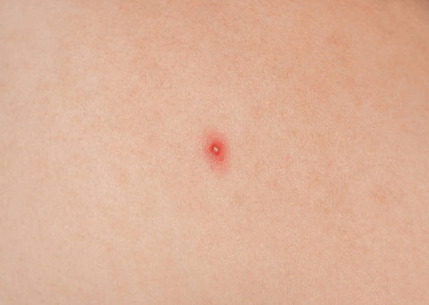 istock Big red pustules on the skin close-up. 638339360