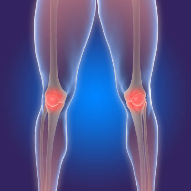 3D illustration of the human knee with arthritis pain stock photo