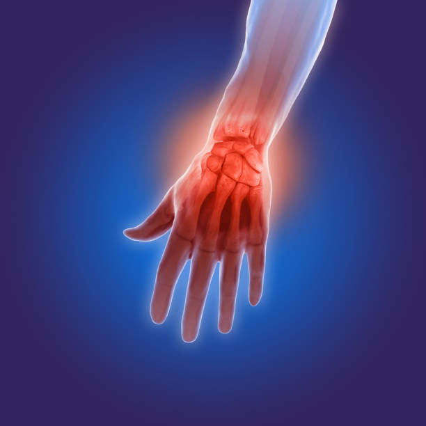 istock 3d illustration of arthritis pain in hand 638753360