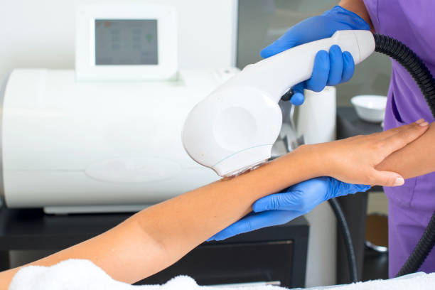istock Laser hair removal on ladies hand 638761626