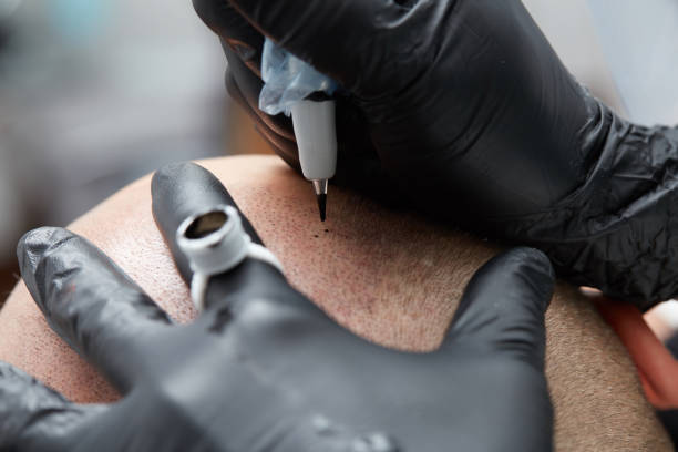 cosmétologue faisant un maquillage permanent sur la tête de l’homme - tricopigmentation - surgical needle photos photos et images de collection