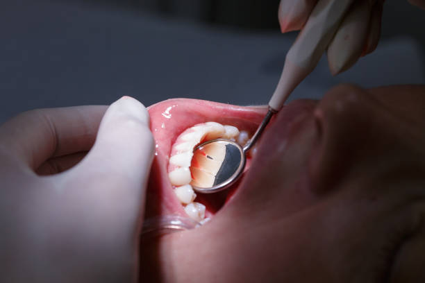 paziente ottenere il interdental spazi esaminato - la bocca apre foto e immagini stock