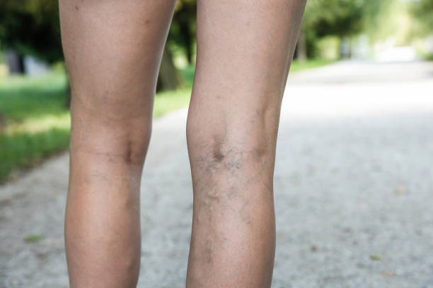 dolor en las venas varicosas y araña en womans legs - vena humana fotografías e imágenes de stock