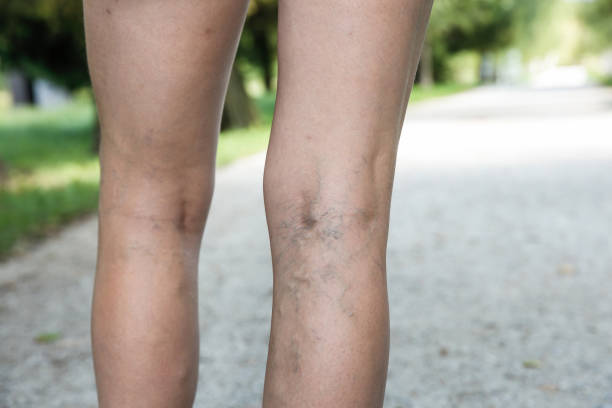 болезненные варикозное расширение вен и паук на womans ноги - animal vein стоковые фото и изображения