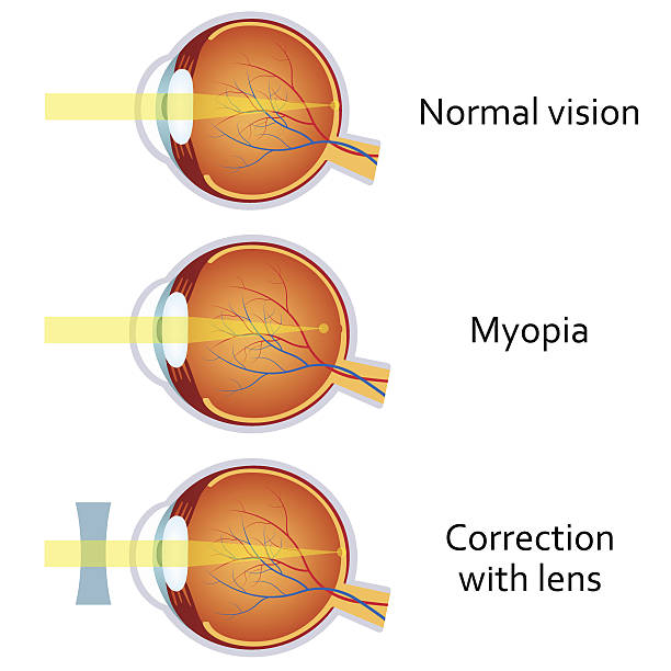 Myopia and myopia corrected by a minus lens. Myopia and myopia corrected by a minus lens. Eye vision disorder. myopia stock illustrations
