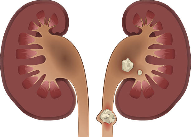 ilustrações, clipart, desenhos animados e ícones de doença das pedras nos rins de nefrise - kidney stone