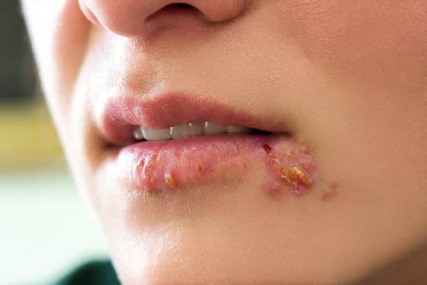 Herpes blisters Girl lips showing herpes blisters herpes stock pictures, royalty-free photos & images