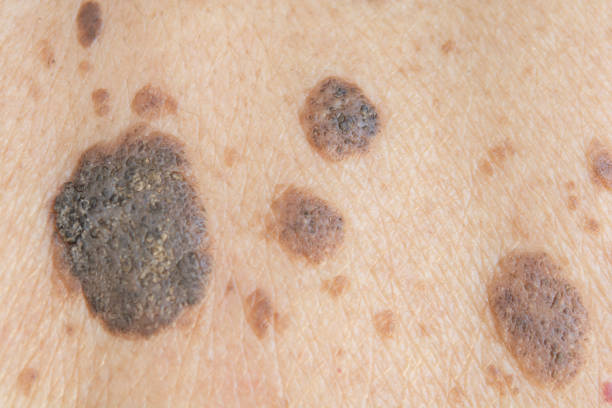 freckles on the skin