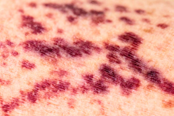 Purpura, vasculitis, or broken blood vessels on human skin Purpura, vasculitis, or broken blood vessels on human skin. Close up shot taken with Canon 5D Mark lV camera. Vasculitis stock pictures, royalty-free photos & images