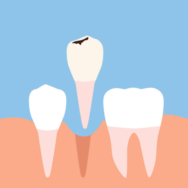 usunięcie uszkodzonego zęba. płaska konstrukcja - human teeth gums dental hygiene inflammation stock illustrations